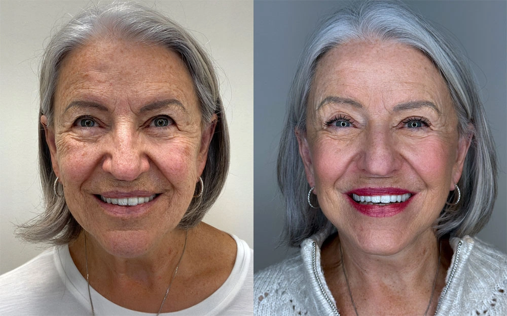 Real patient results in Montreal, QC Performed by Emily Deane, MD