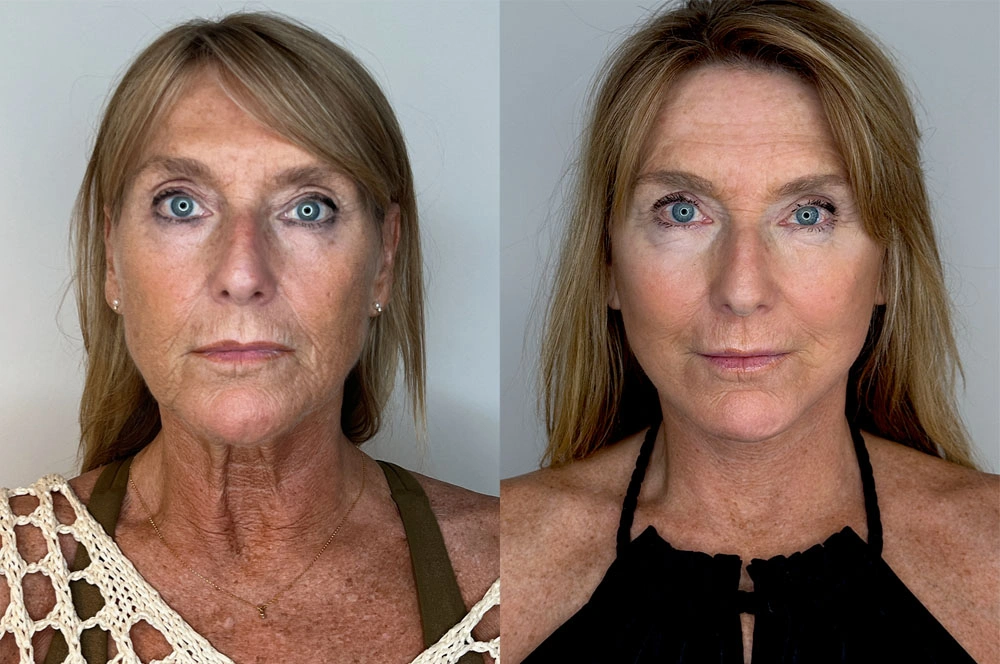 Real patient results in Montreal, QC Performed by Emily Deane, MD