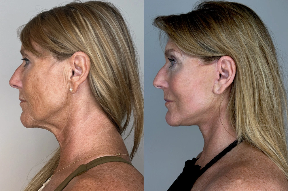 Real patient results in Montreal, QC Performed by Emily Deane, MD