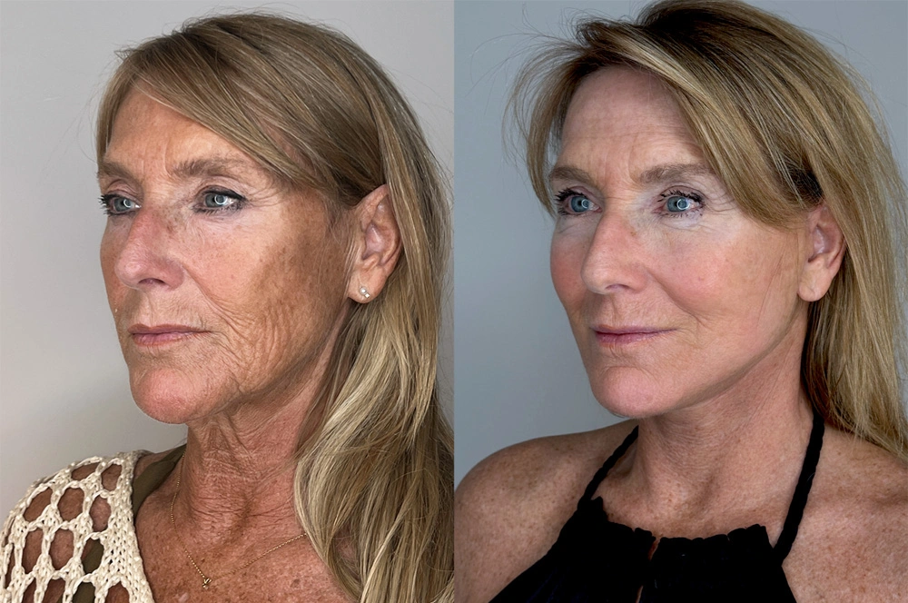 Real patient results in Montreal, QC Performed by Emily Deane, MD