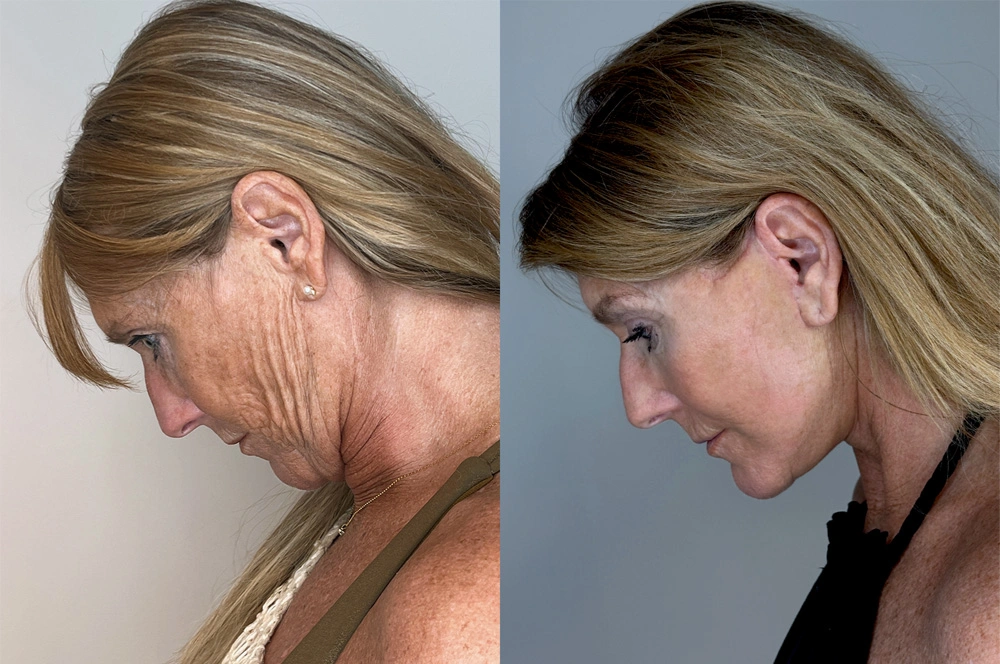 Real patient results in Montreal, QC Performed by Emily Deane, MD
