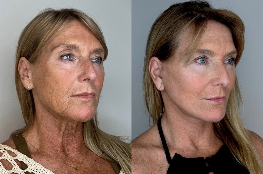 Real patient results in Montreal, QC Performed by Emily Deane, MD