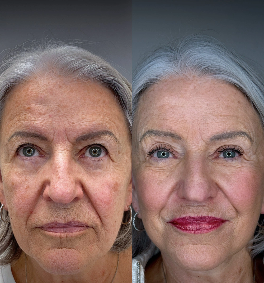 Real patient results in Montreal, QC Performed by Emily Deane, MD
