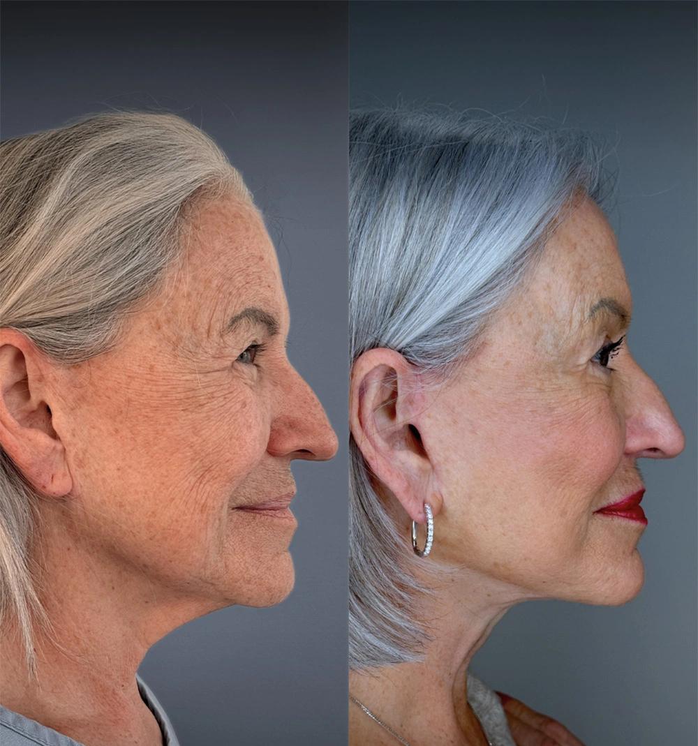 Real patient results in Montreal, QC Performed by Emily Deane, MD