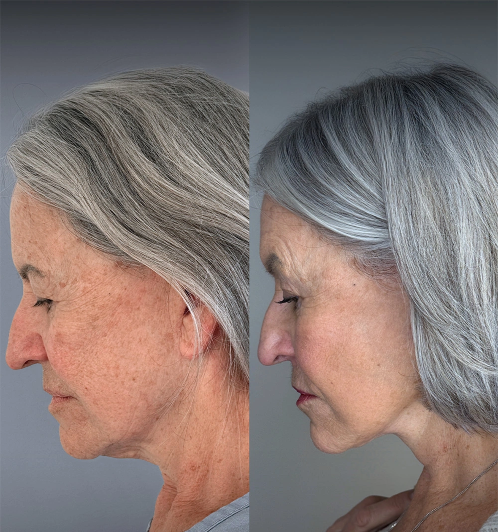 Real patient results in Montreal, QC Performed by Emily Deane, MD