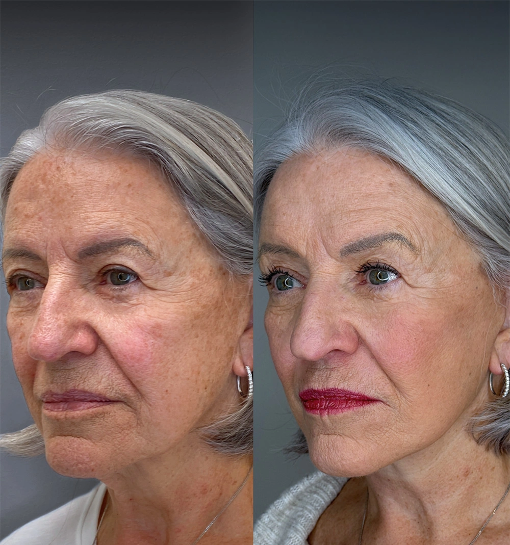 Real patient results in Montreal, QC Performed by Emily Deane, MD