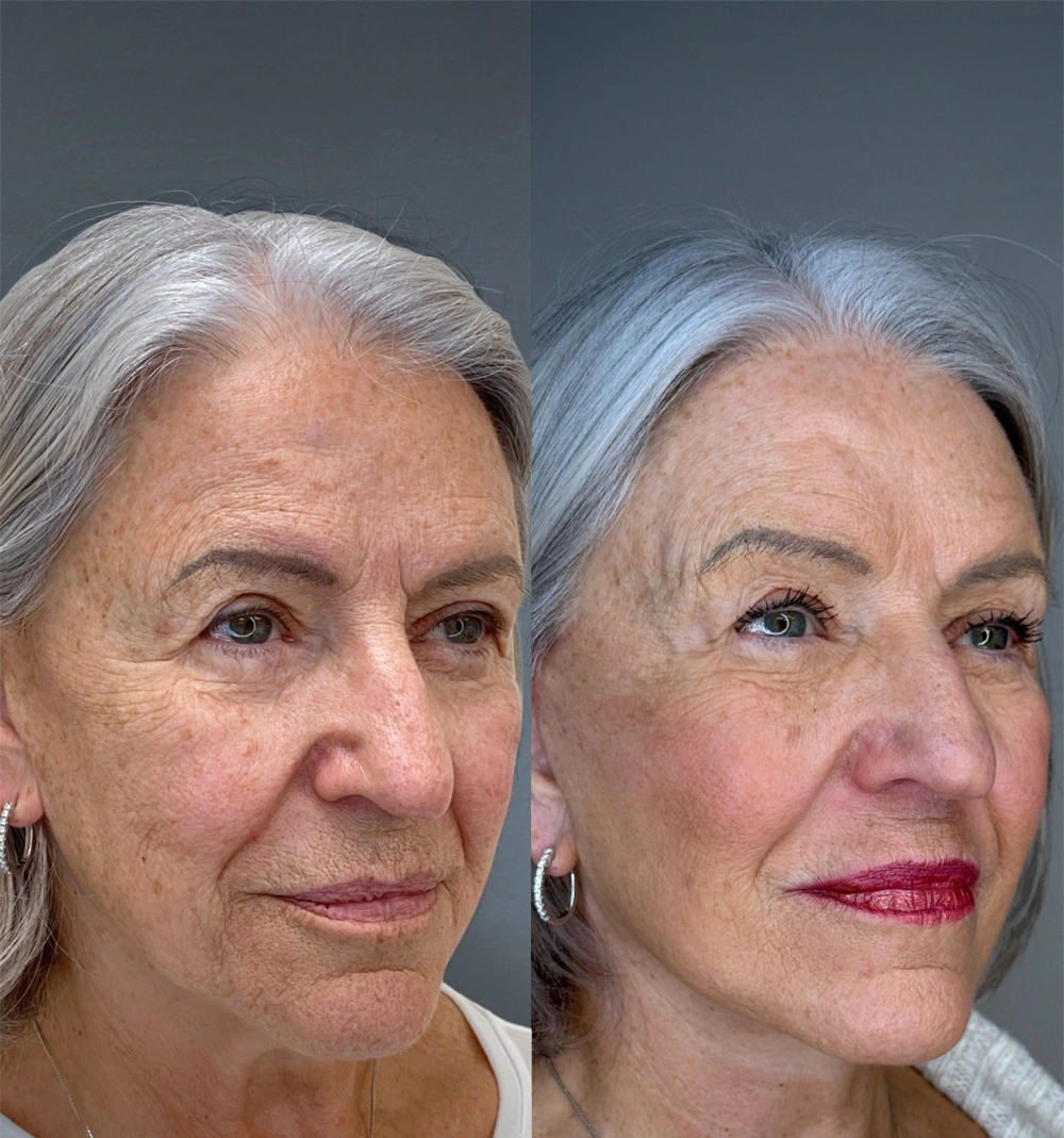 Real patient results in Montreal, QC Performed by Emily Deane, MD