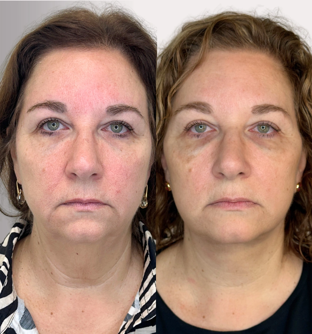 Real patient results in Montreal, QC Performed by Emily Deane, MD