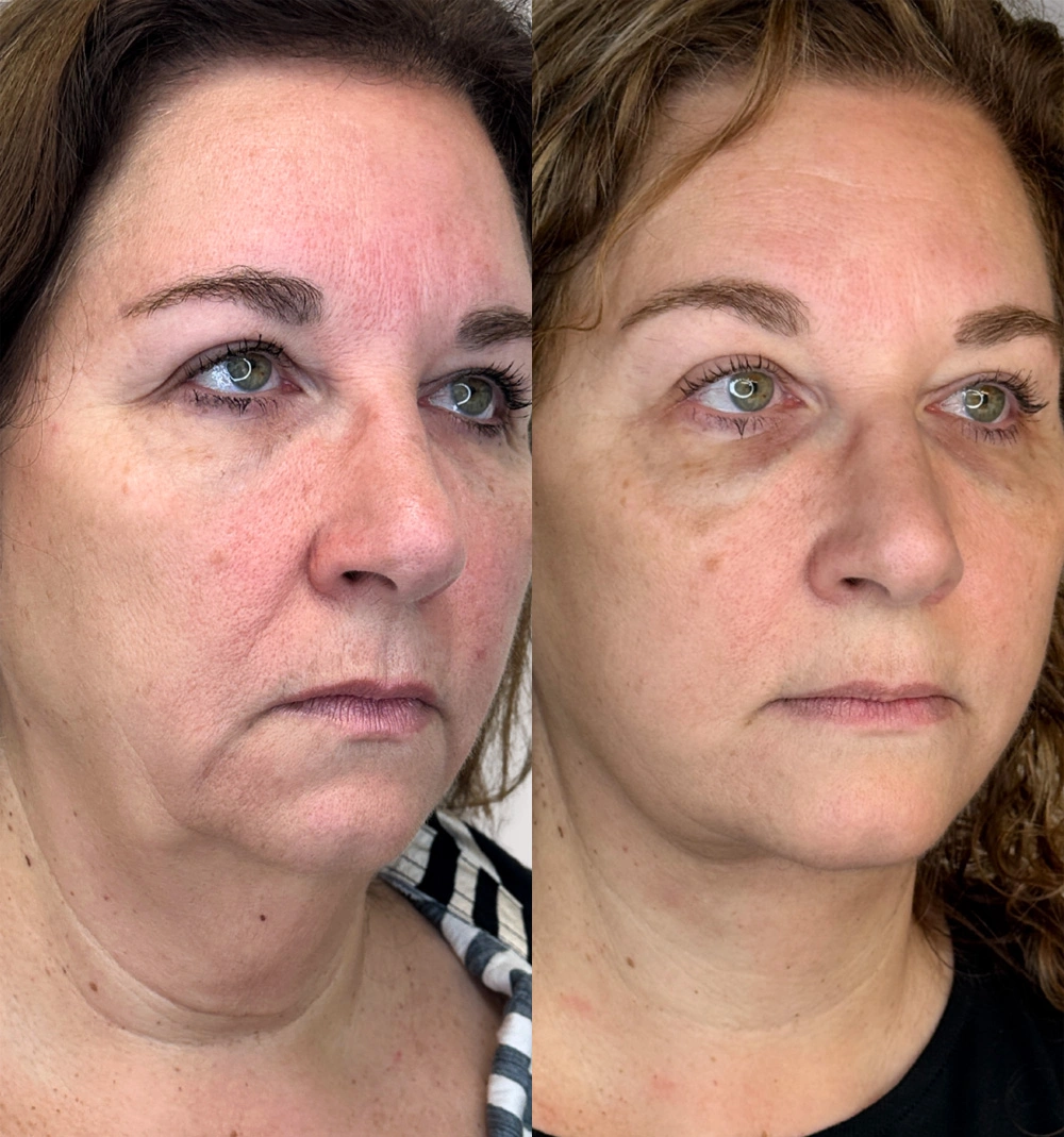 Real patient results in Montreal, QC Performed by Emily Deane, MD