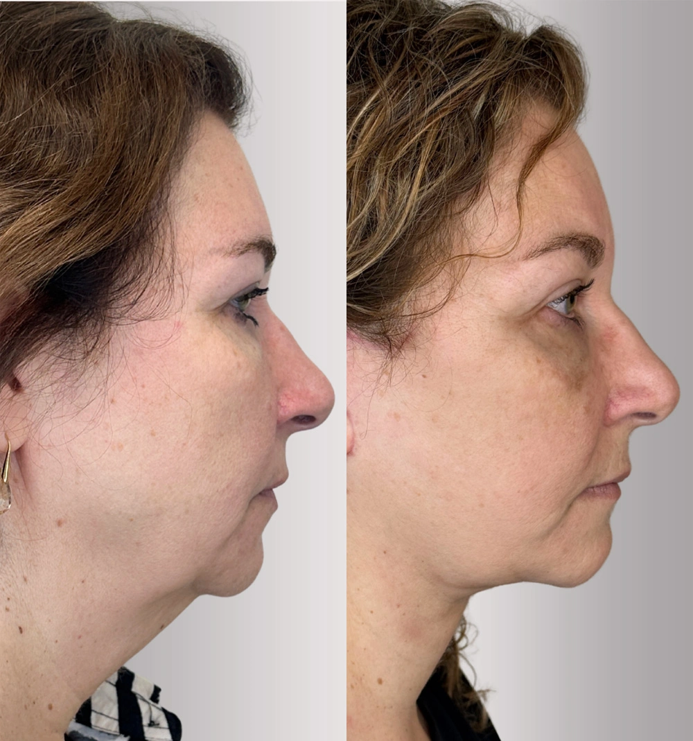 Real patient results in Montreal, QC Performed by Emily Deane, MD
