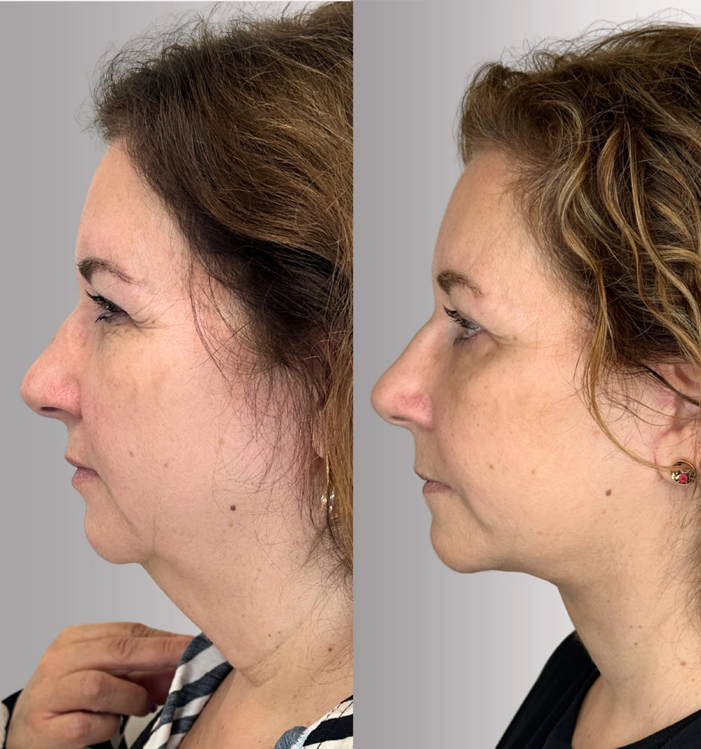 Real patient results in Montreal, QC Performed by Emily Deane, MD