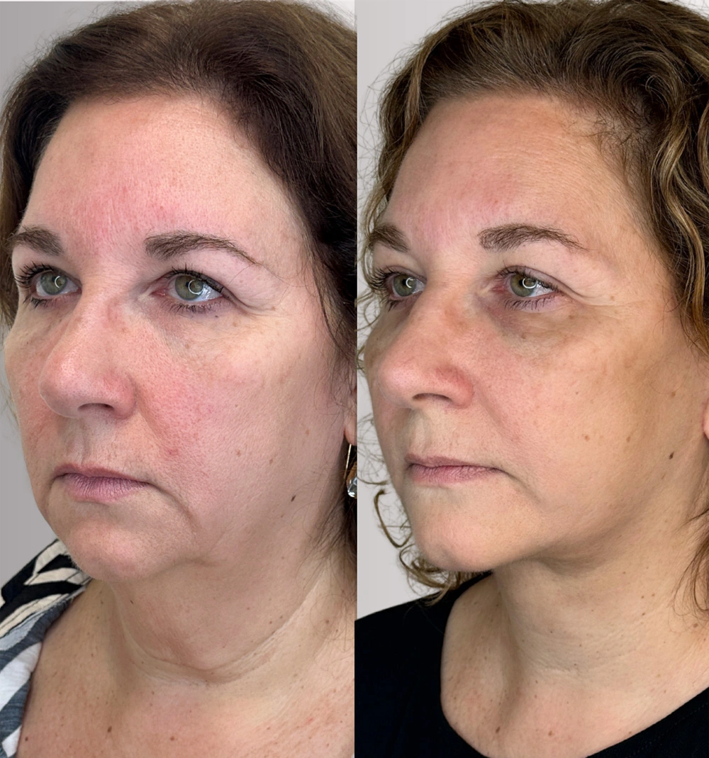 Real patient results in Montreal, QC Performed by Emily Deane, MD