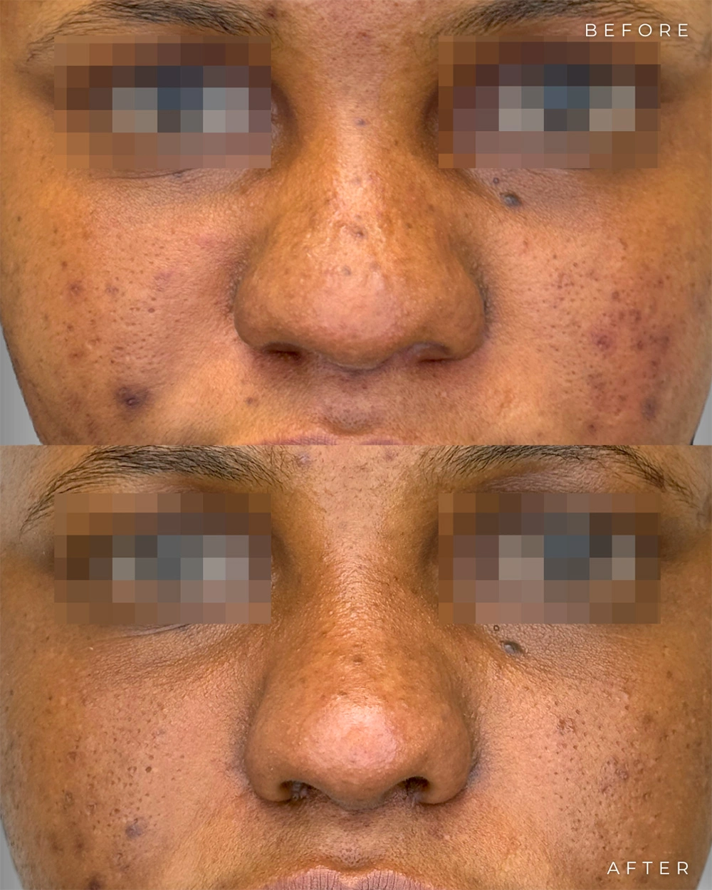 Real patient results in Montreal, QC Performed by Emily Deane, MD