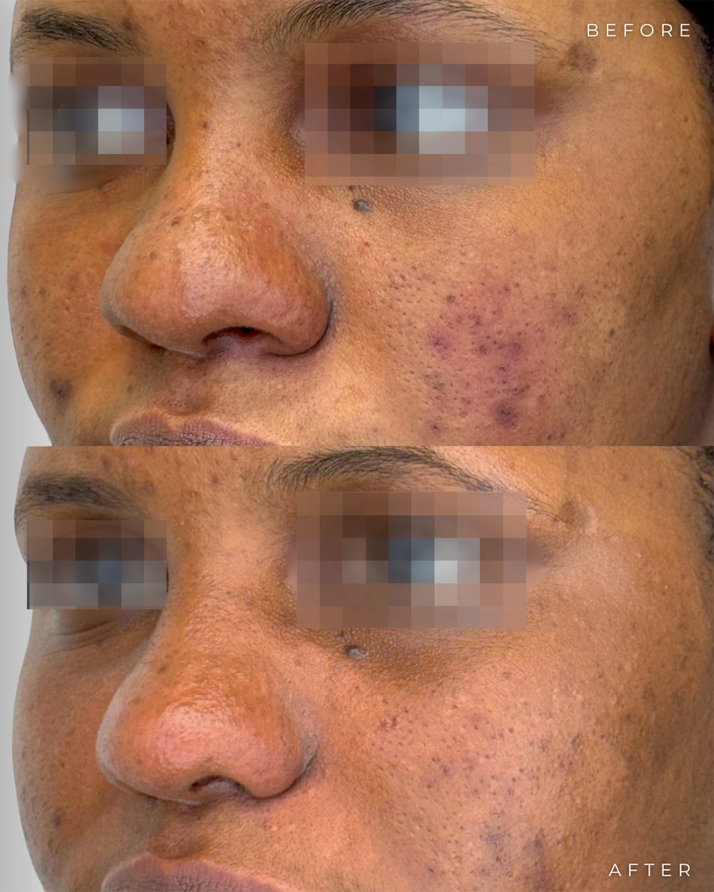 Real patient results in Montreal, QC Performed by Emily Deane, MD