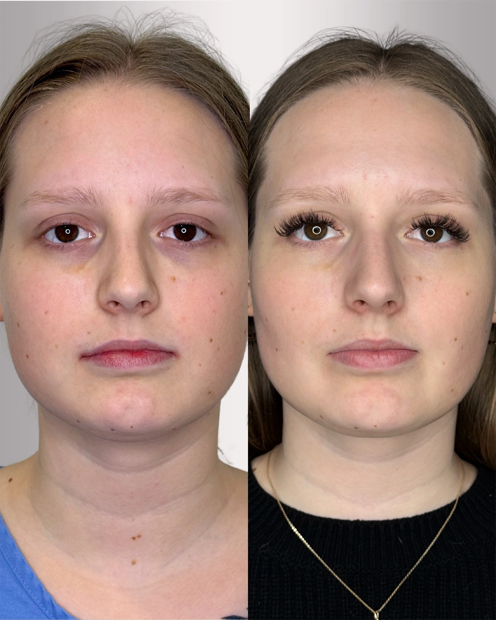Real patient results in Montreal, QC Performed by Emily Deane, MD