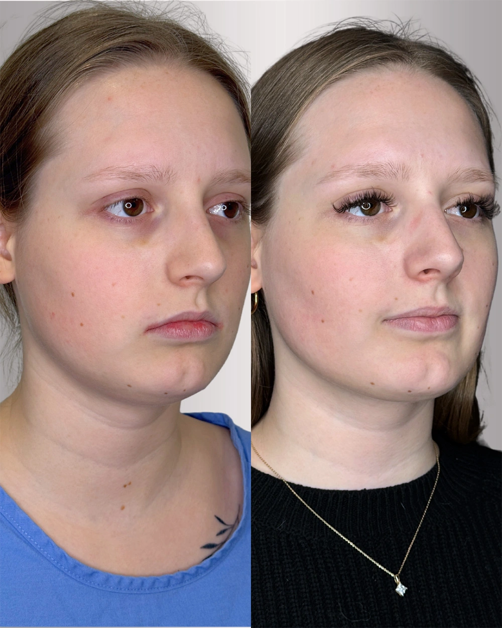 Real patient results in Montreal, QC Performed by Emily Deane, MD