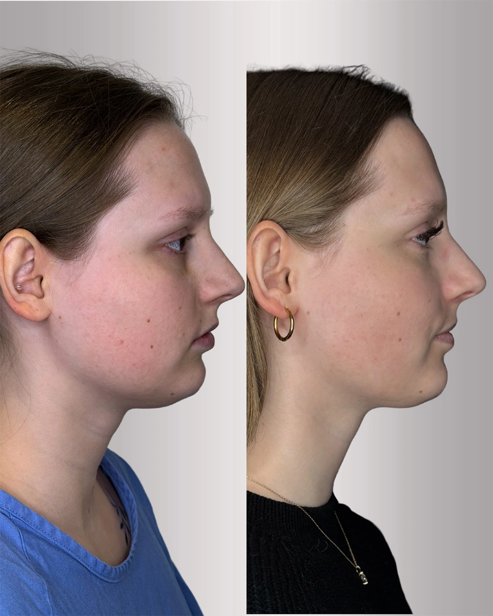 Real patient results in Montreal, QC Performed by Emily Deane, MD