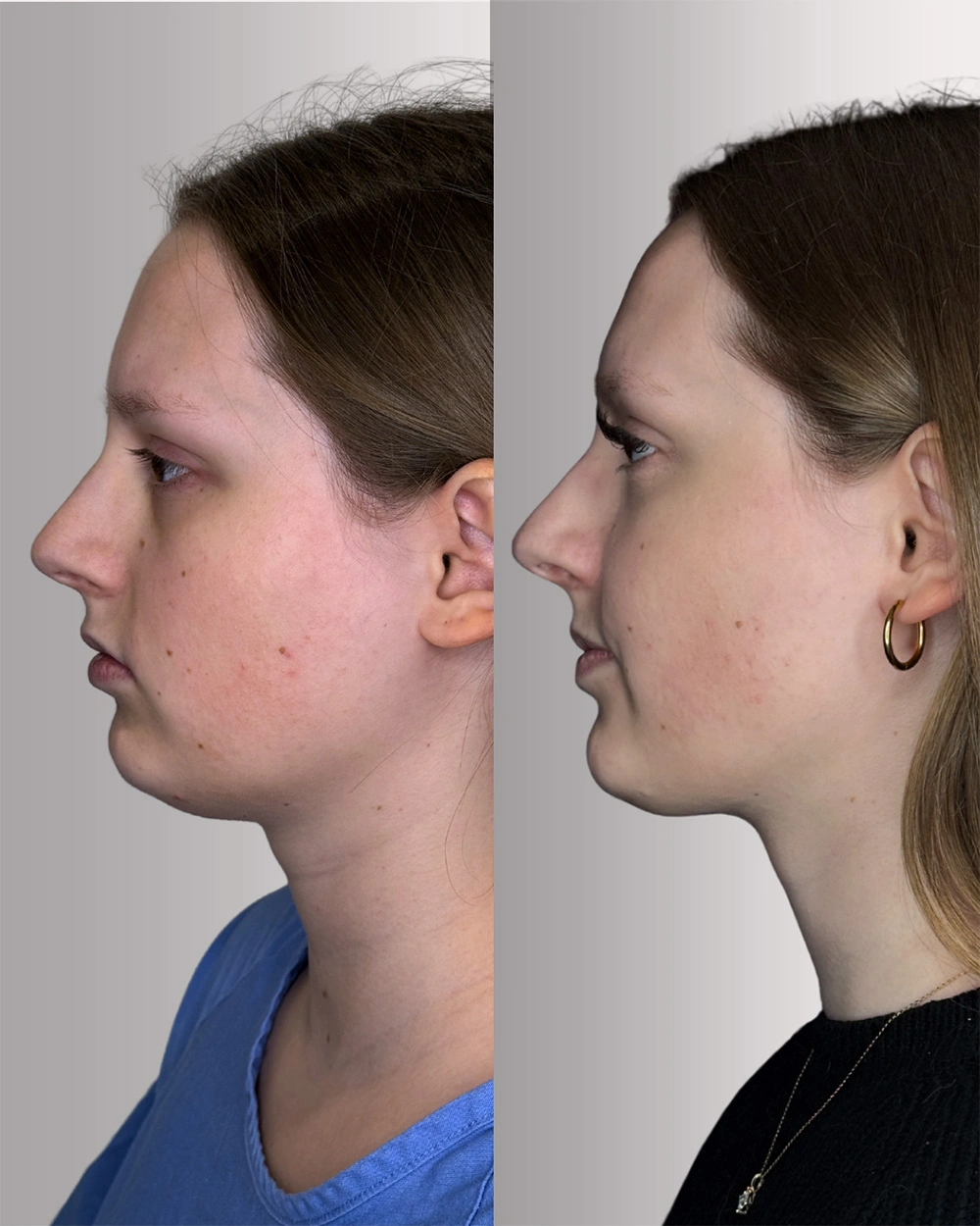 Real patient results in Montreal, QC Performed by Emily Deane, MD