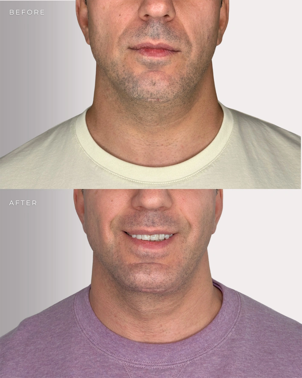 Real patient results in Montreal, QC Performed by Emily Deane, MD