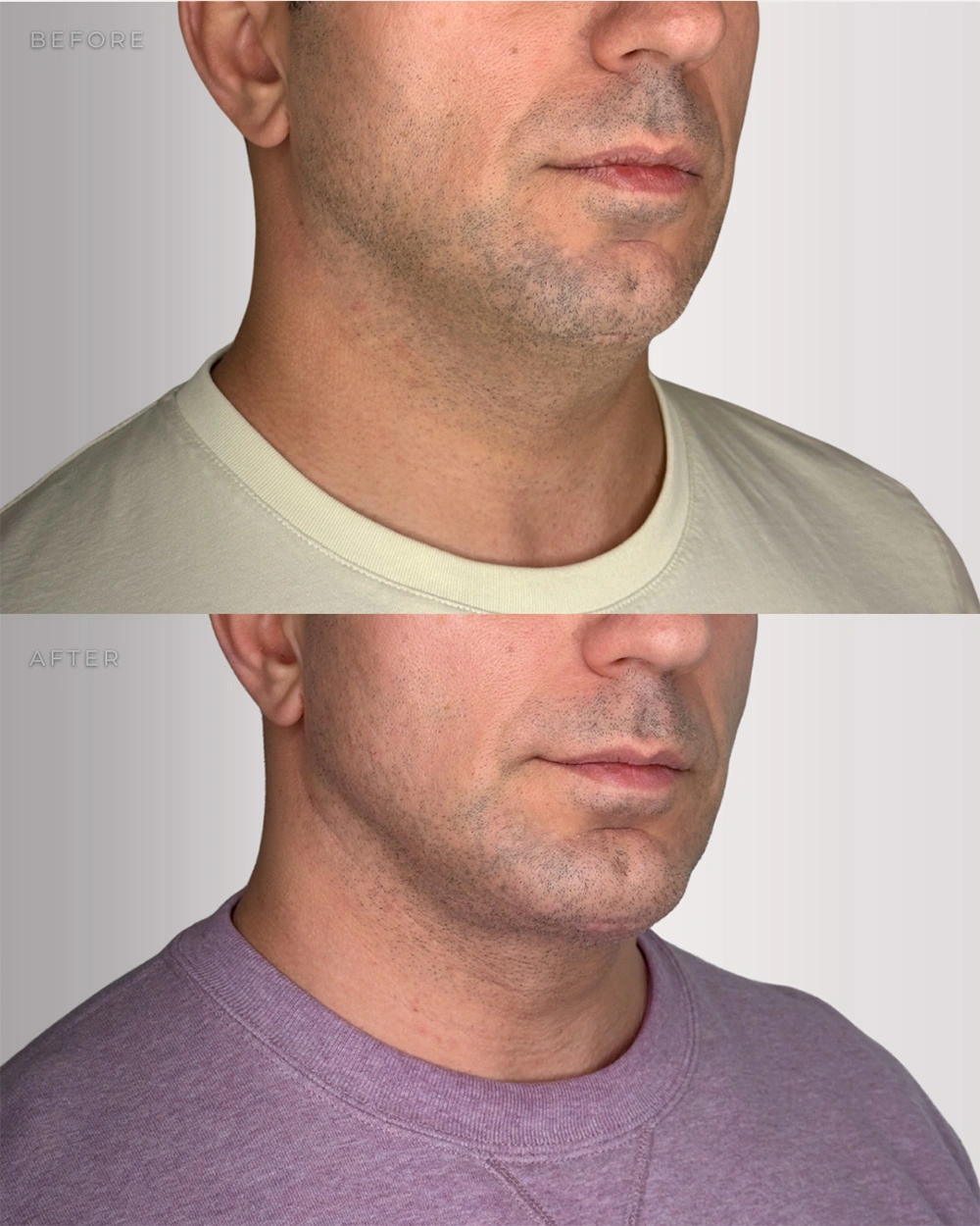 Real patient results in Montreal, QC Performed by Emily Deane, MD