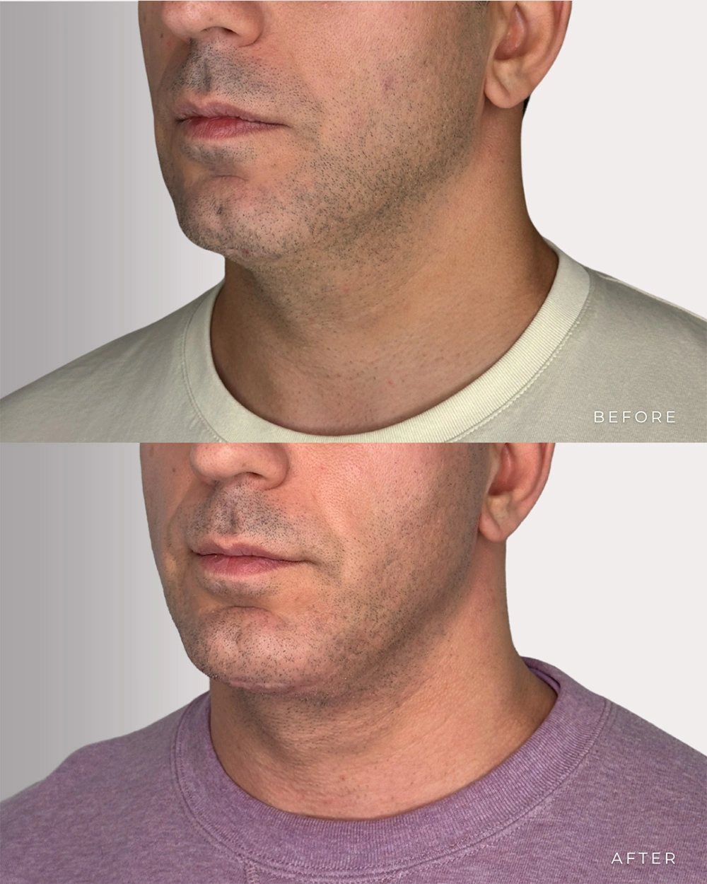 Real patient results in Montreal, QC Performed by Emily Deane, MD