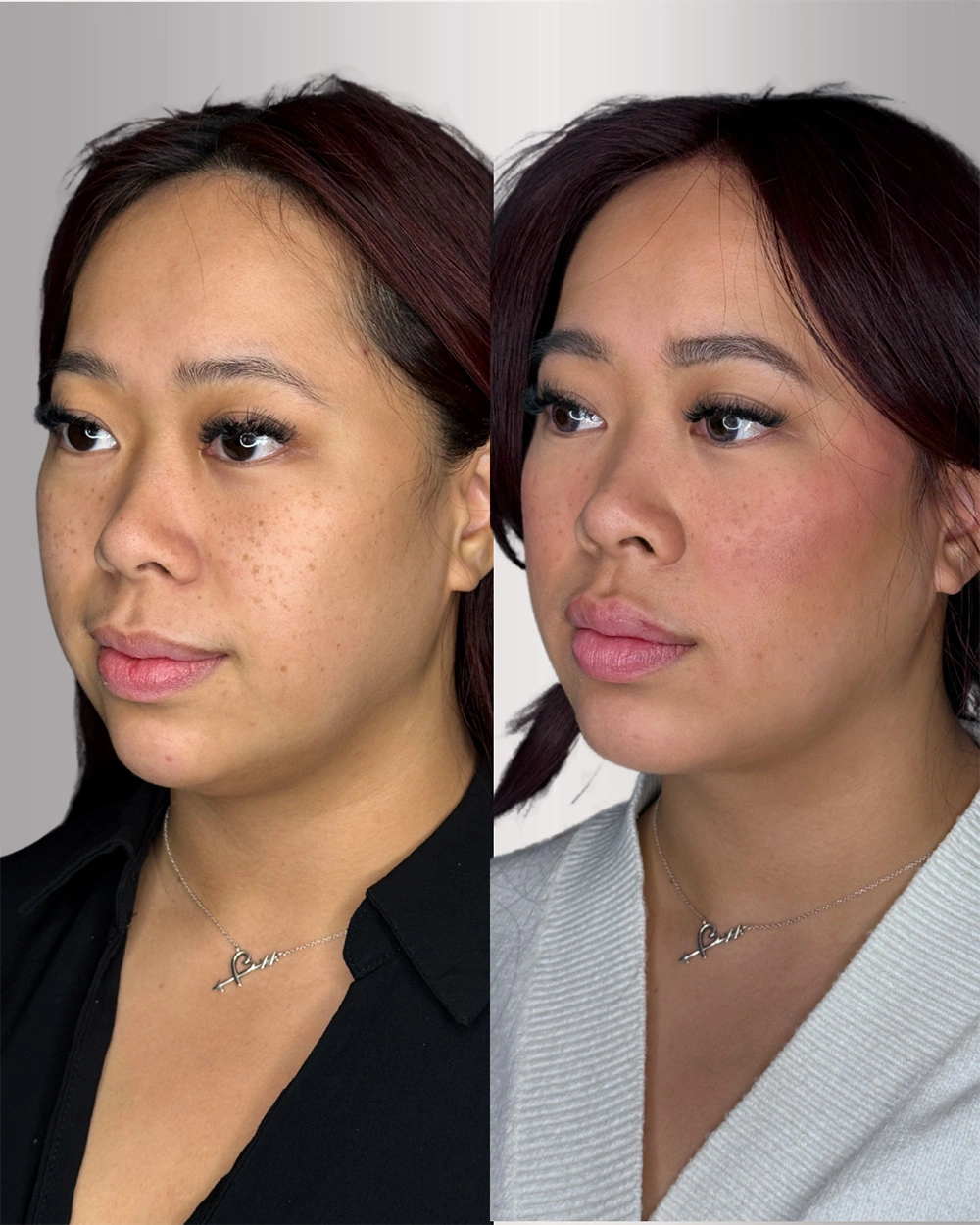Real patient results in Montreal, QC Performed by Emily Deane, MD