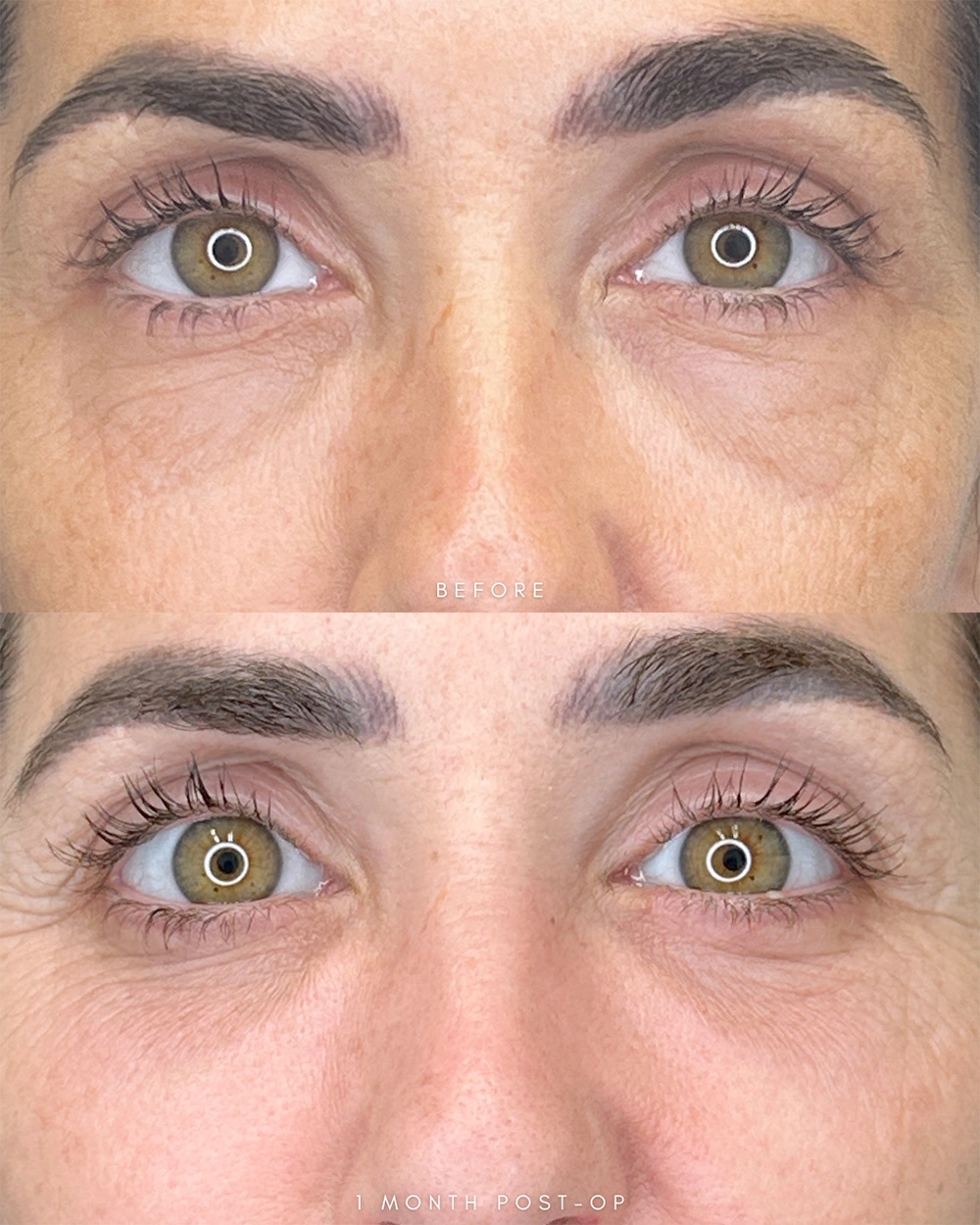 Real patient results in Montreal, QC Performed by Emily Deane, MD