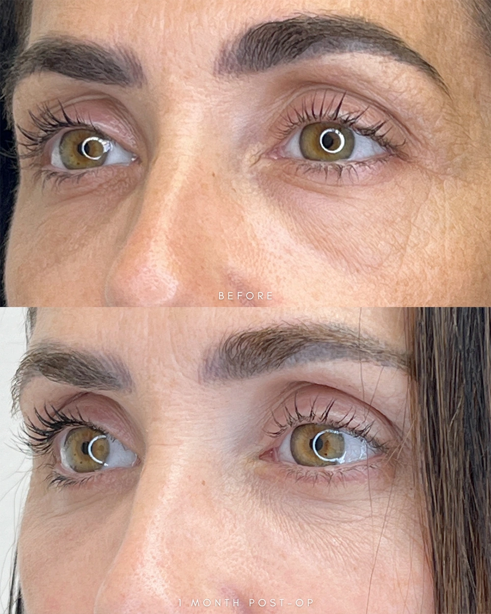 Real patient results in Montreal, QC Performed by Emily Deane, MD
