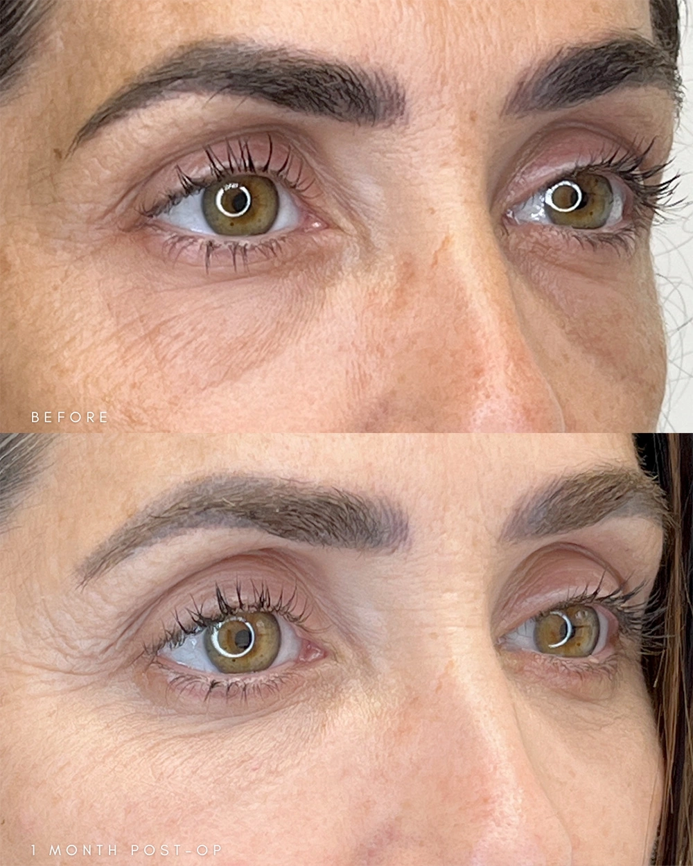 Real patient results in Montreal, QC Performed by Emily Deane, MD