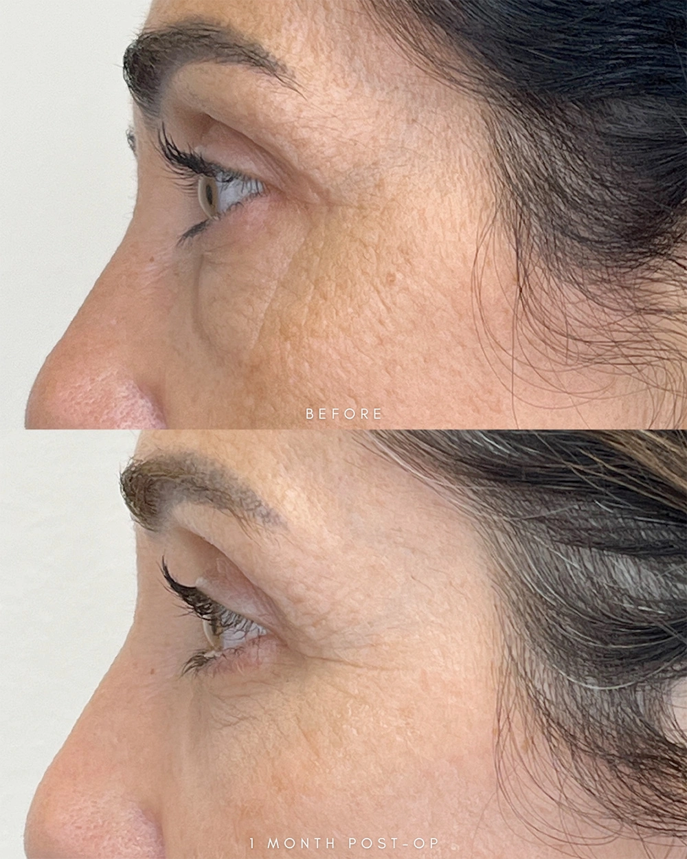 Real patient results in Montreal, QC Performed by Emily Deane, MD