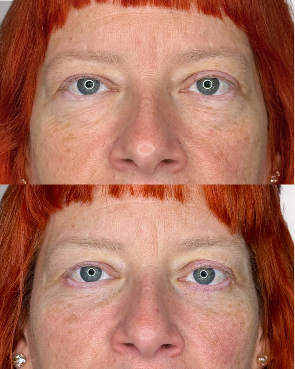 Real patient results in Montreal, QC Performed by Emily Deane, MD