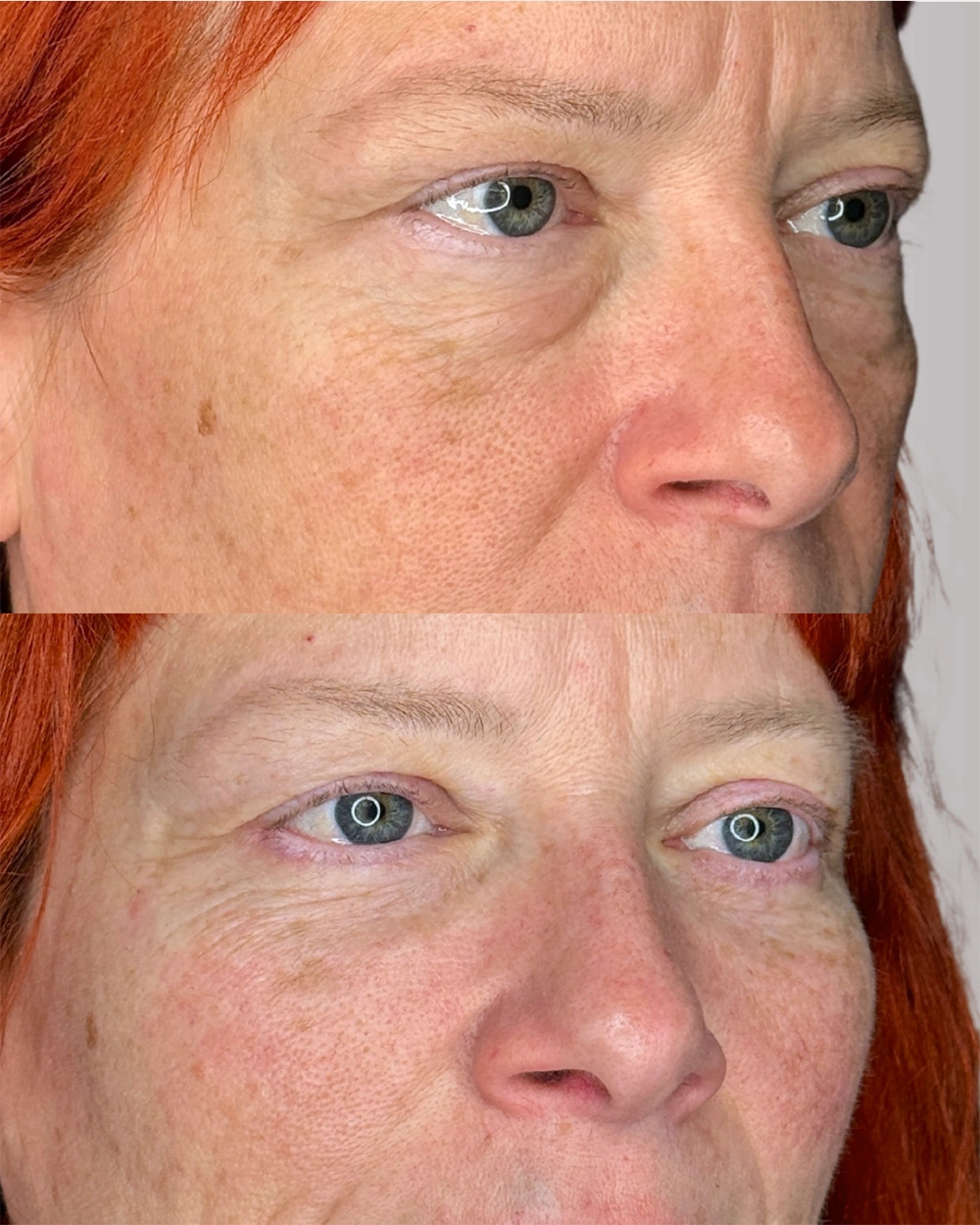 Real patient results in Montreal, QC Performed by Emily Deane, MD