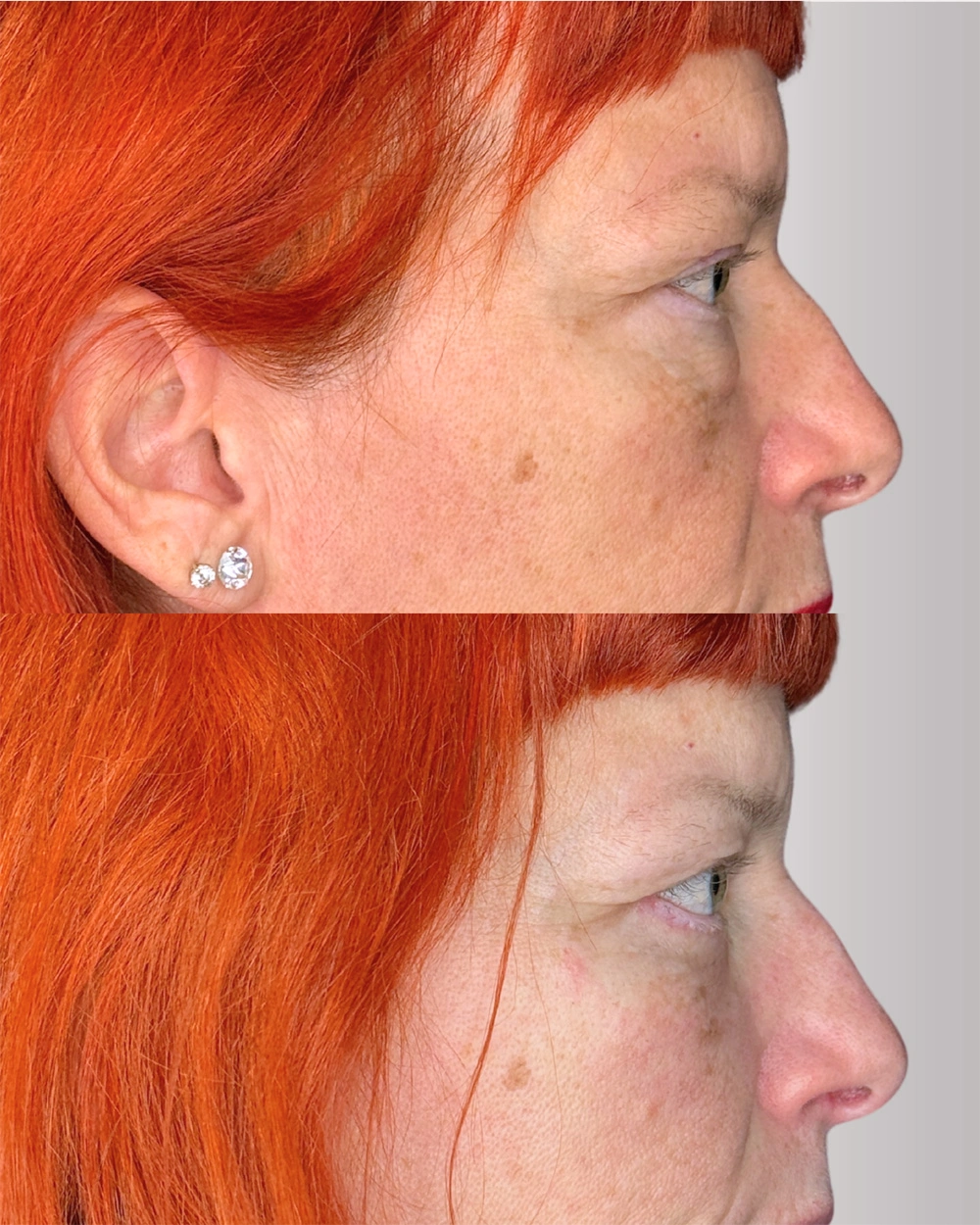 Real patient results in Montreal, QC Performed by Emily Deane, MD