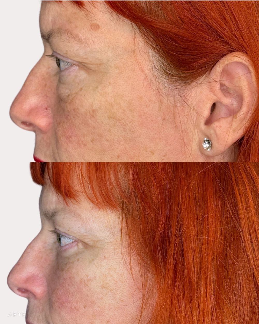 Real patient results in Montreal, QC Performed by Emily Deane, MD