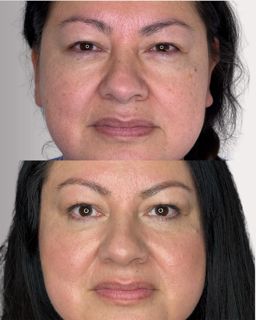 Real patient results in Montreal, QC Performed by Emily Deane, MD