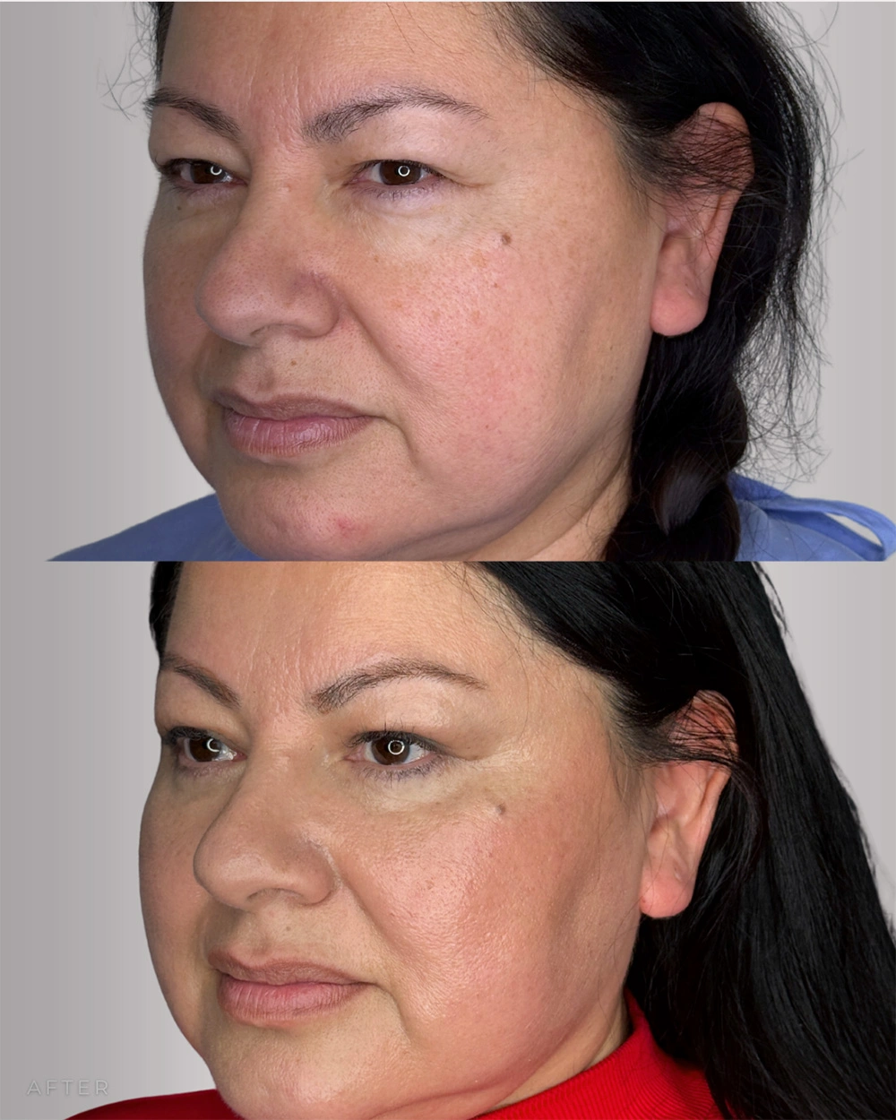 Real patient results in Montreal, QC Performed by Emily Deane, MD