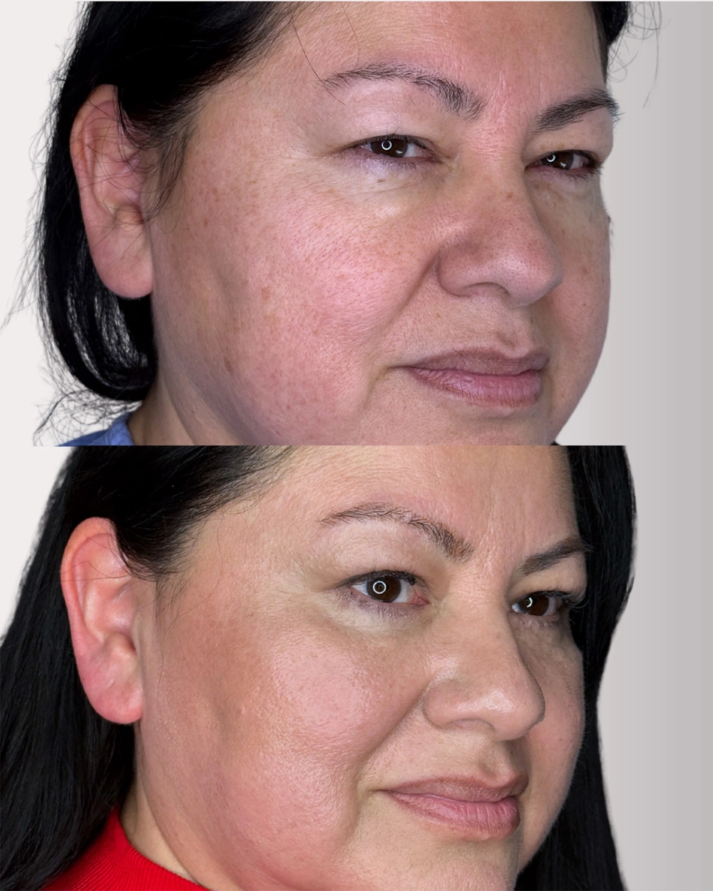 Real patient results in Montreal, QC Performed by Emily Deane, MD