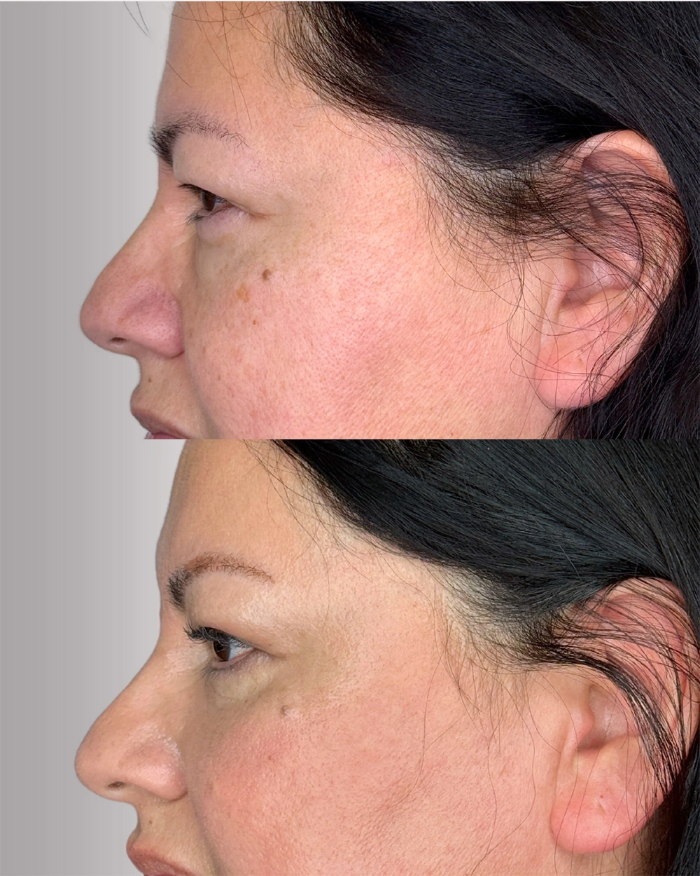 Real patient results in Montreal, QC Performed by Emily Deane, MD