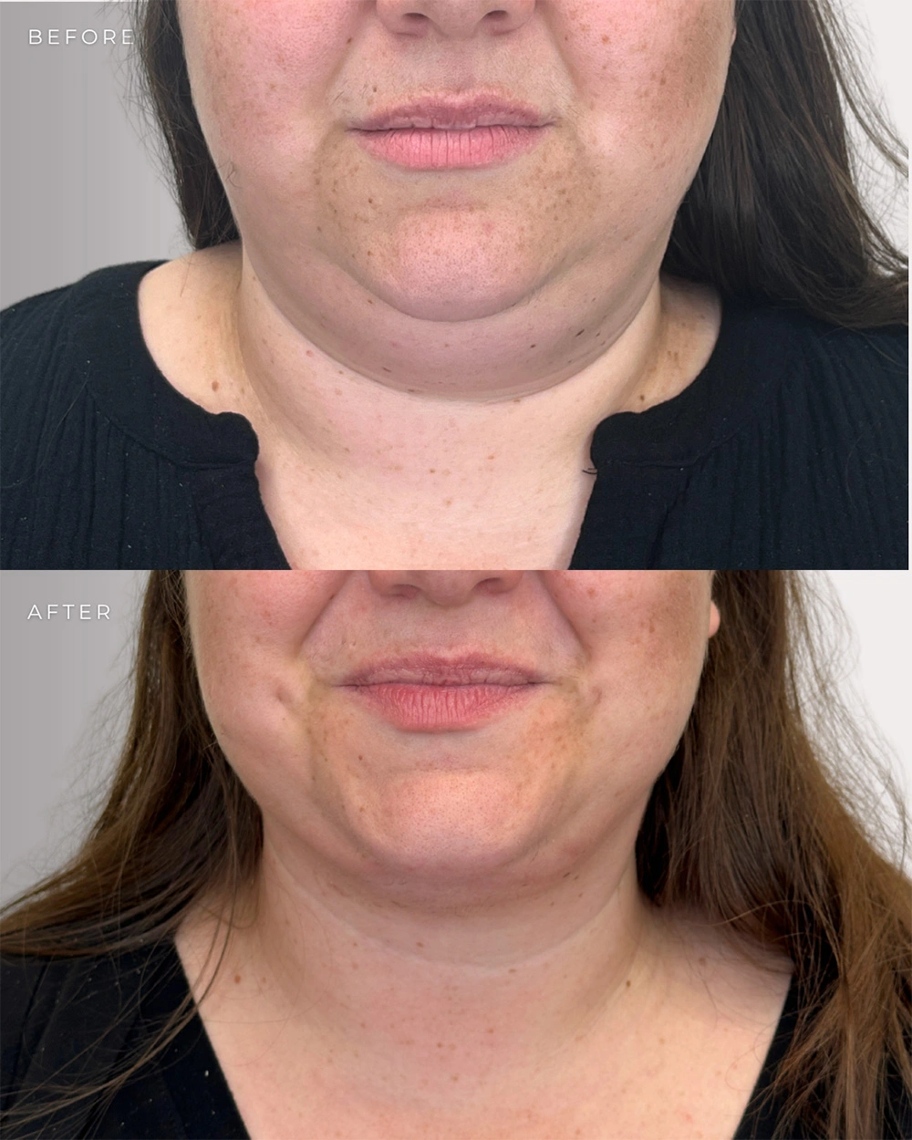 Real patient results in Montreal, QC Performed by Emily Deane, MD