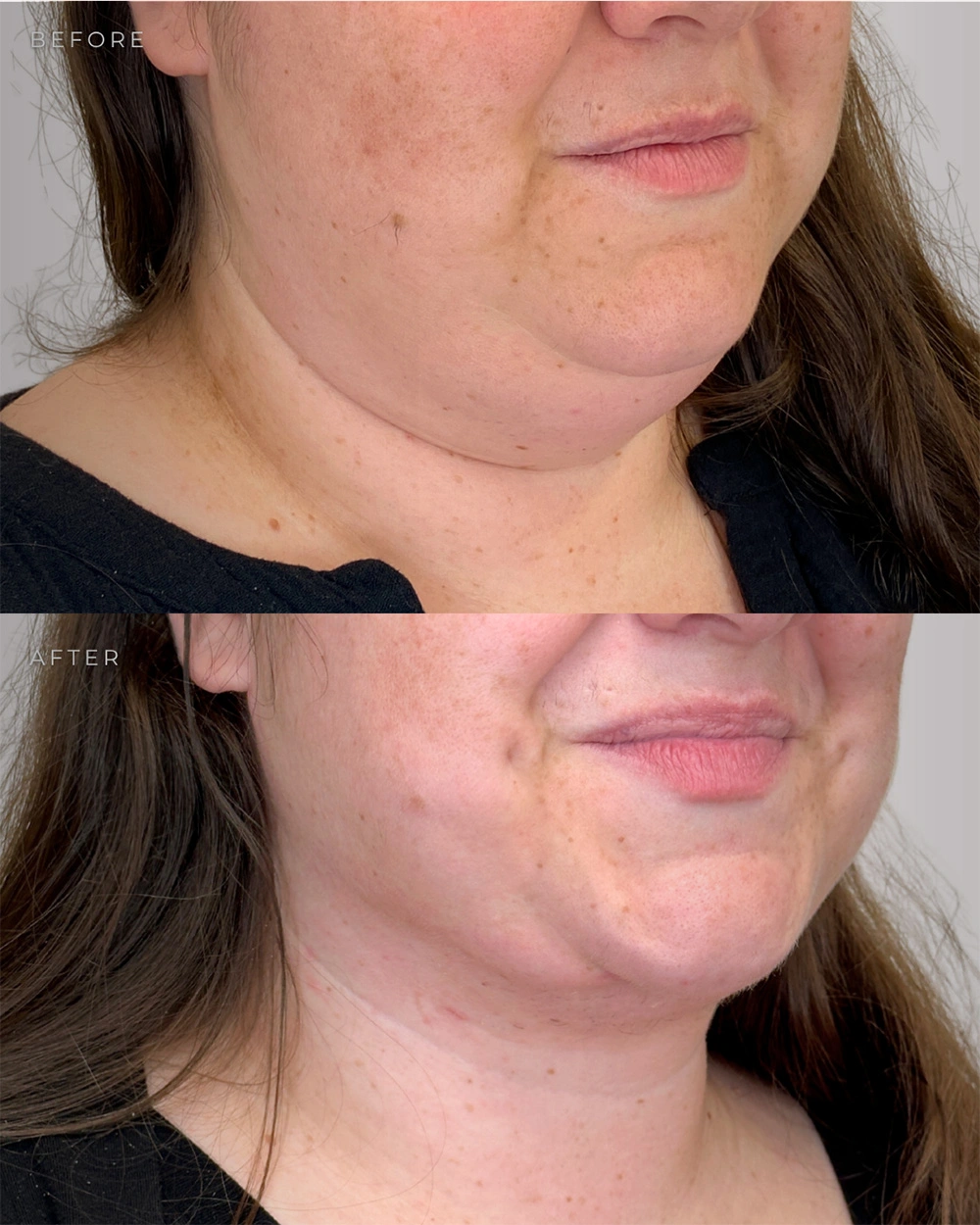 Real patient results in Montreal, QC Performed by Emily Deane, MD