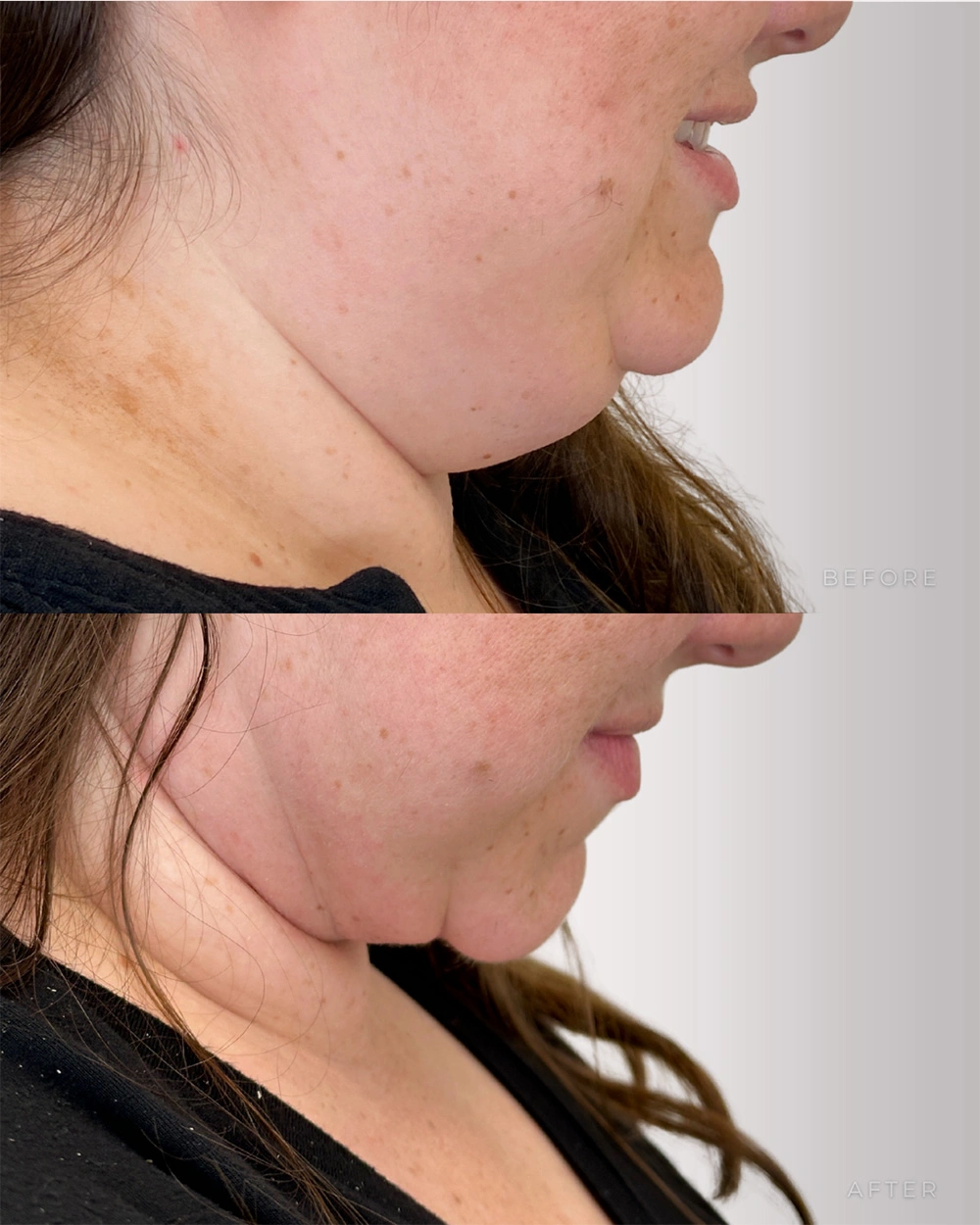 Real patient results in Montreal, QC Performed by Emily Deane, MD