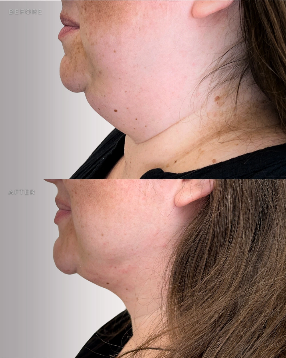 Real patient results in Montreal, QC Performed by Emily Deane, MD