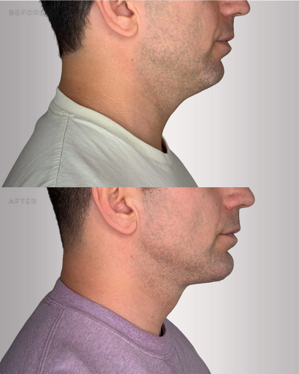 Real patient results in Montreal, QC Performed by Emily Deane, MD