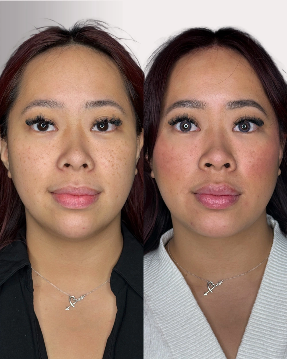 Real patient results in Montreal, QC Performed by Emily Deane, MD