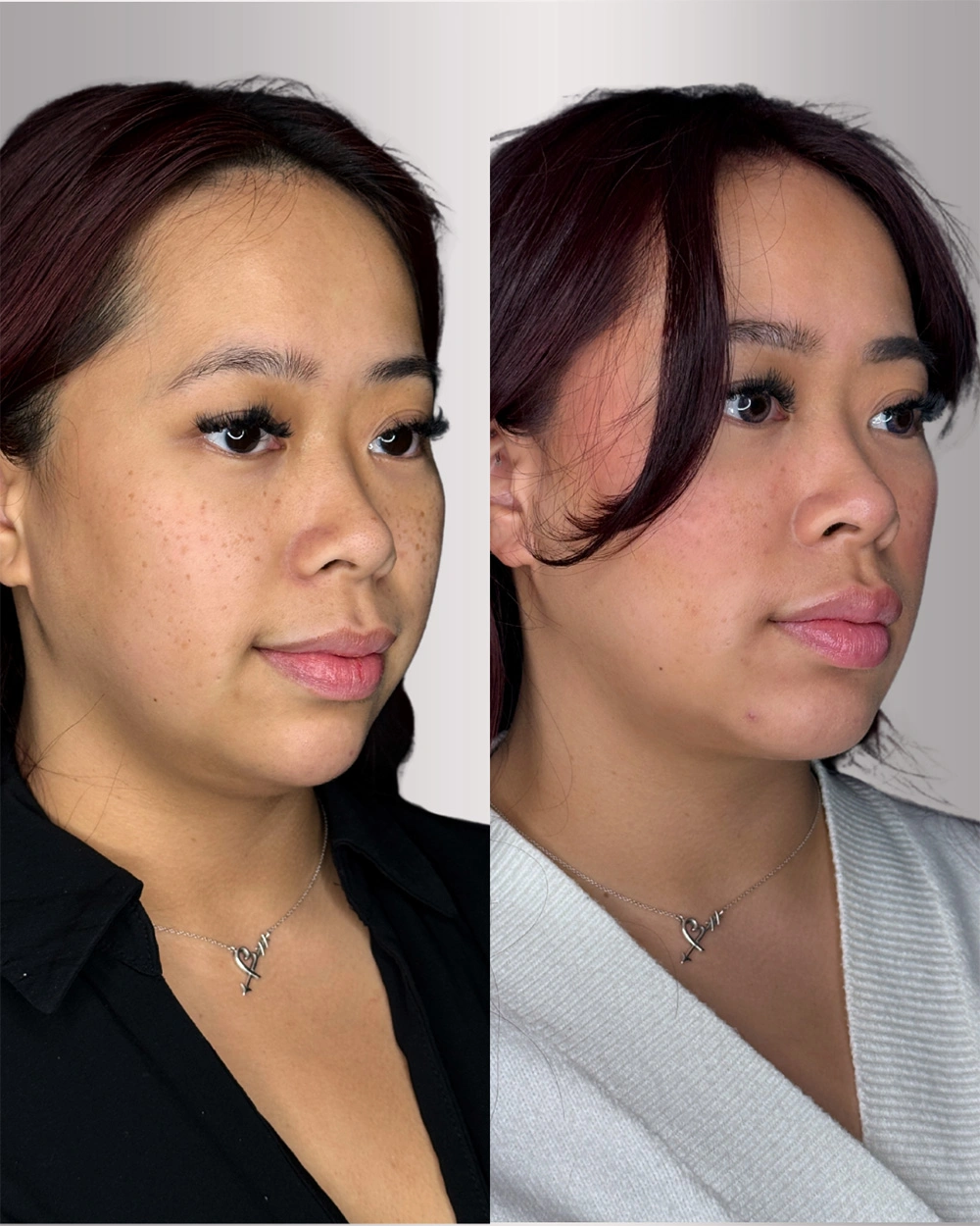 Real patient results in Montreal, QC Performed by Emily Deane, MD