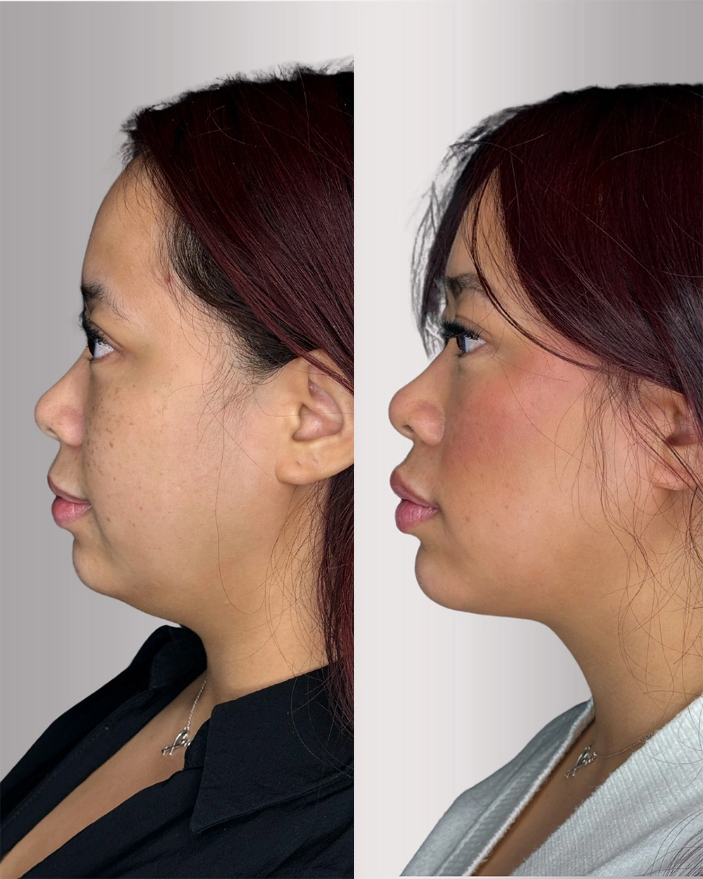 Real patient results in Montreal, QC Performed by Emily Deane, MD