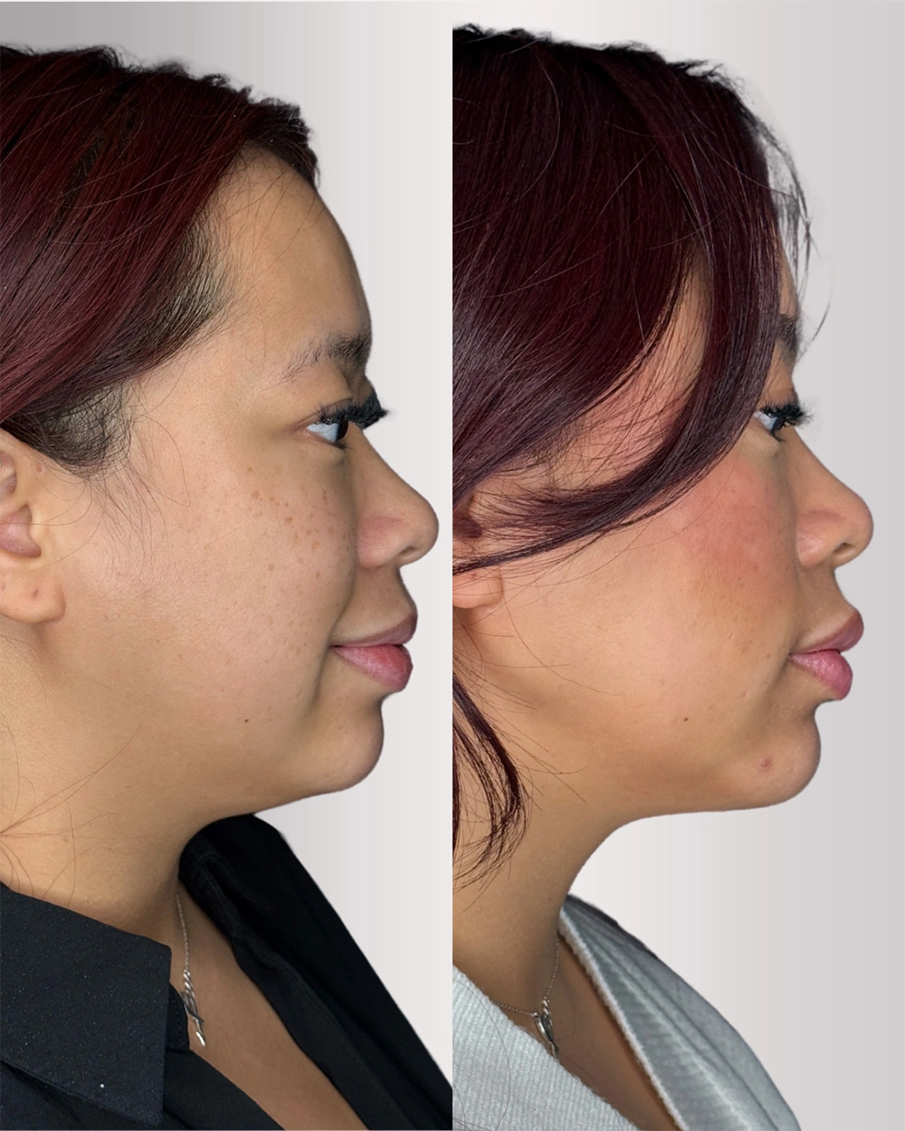 Real patient results in Montreal, QC Performed by Emily Deane, MD