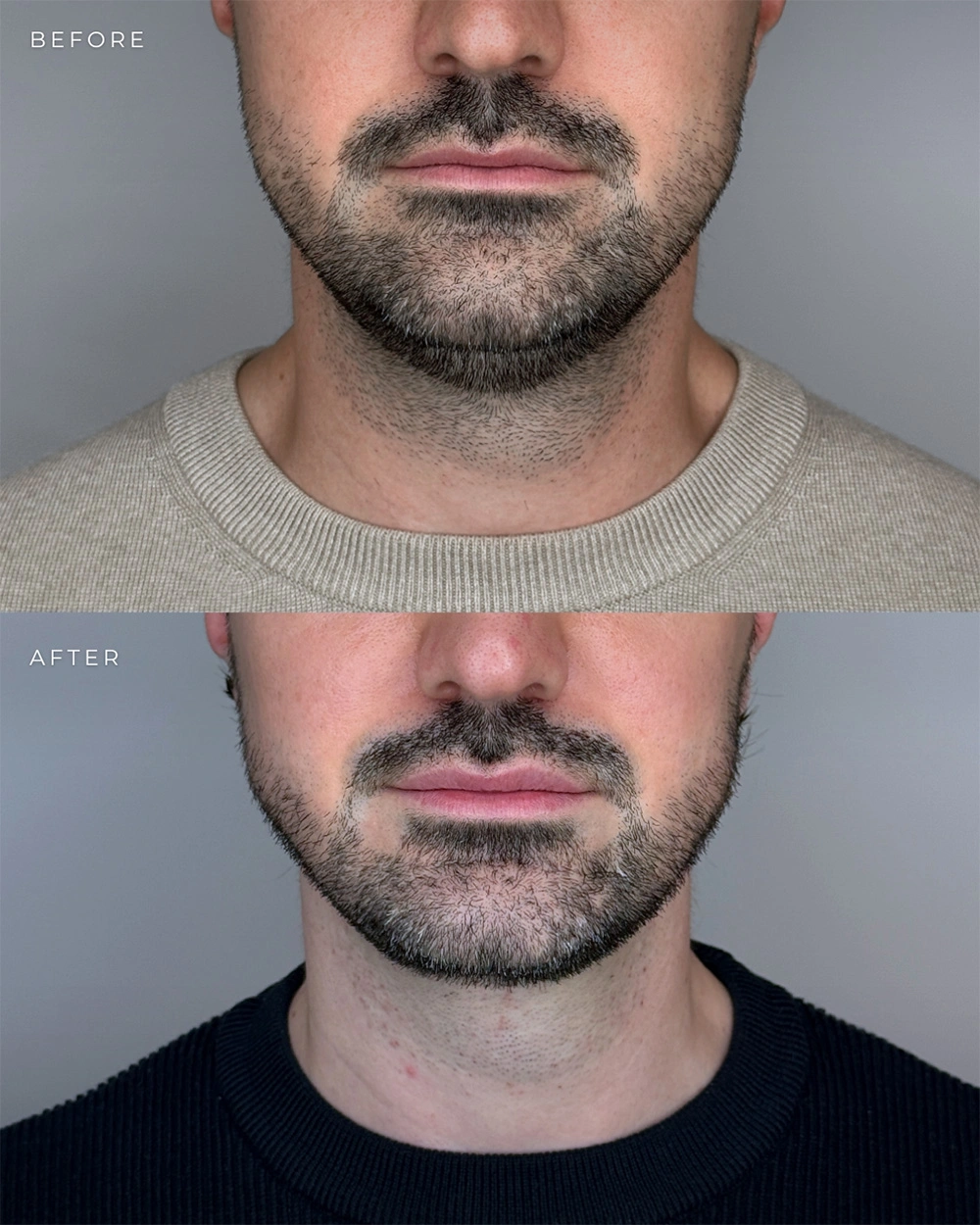 Real patient results in Montreal, QC Performed by Emily Deane, MD