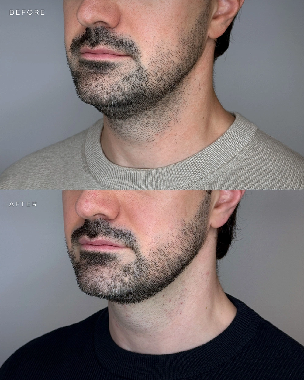 Real patient results in Montreal, QC Performed by Emily Deane, MD