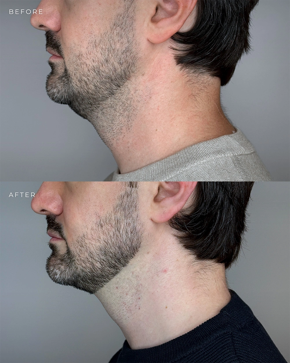 Real patient results in Montreal, QC Performed by Emily Deane, MD